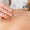 Acupuncture for 10 Days