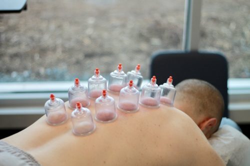 Cupping Therapy